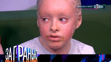 «Мальчик в чешуе» 23.03.2024